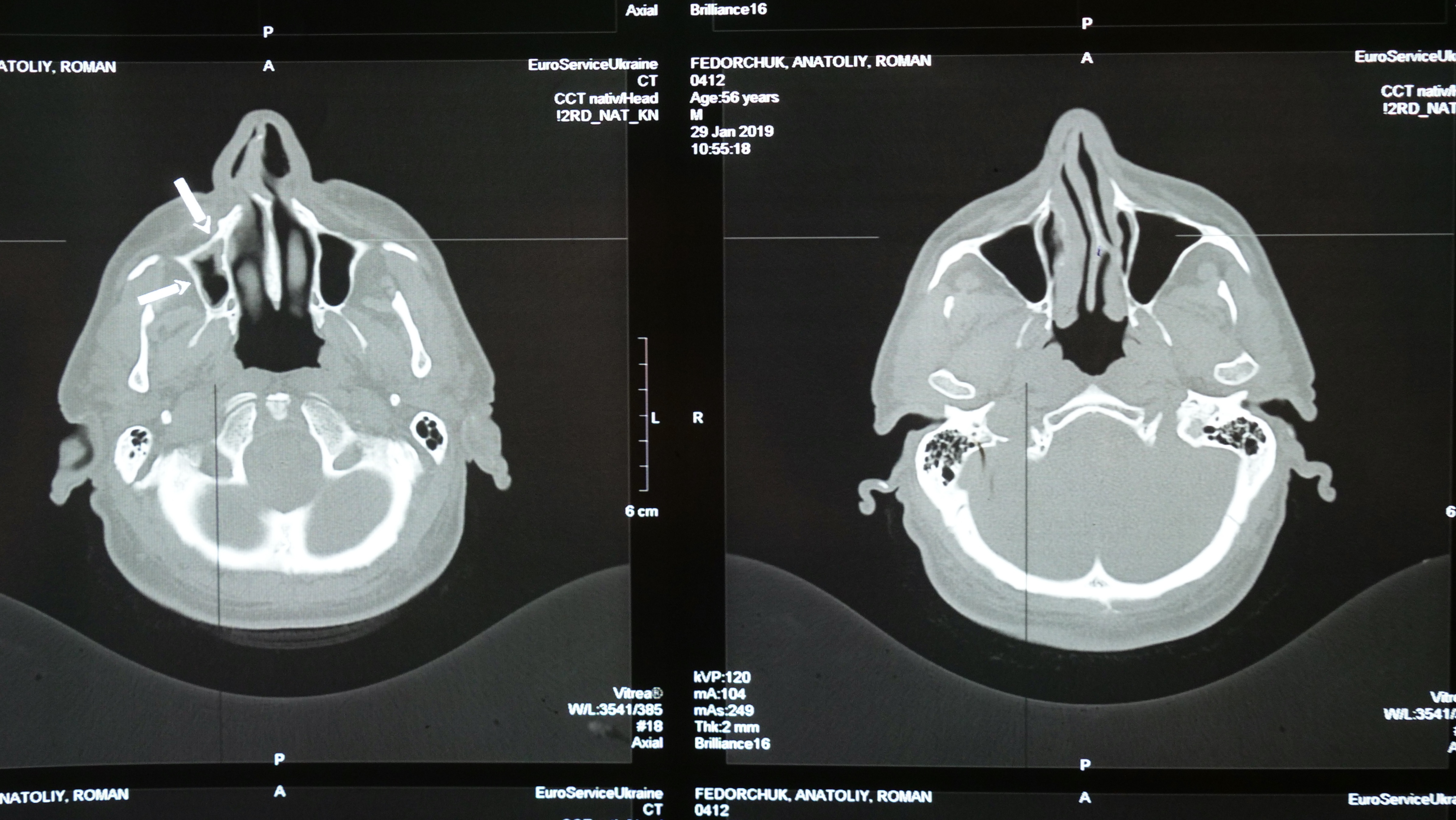 An MRI of a brain
